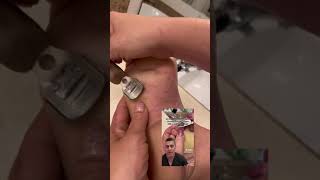 Podiatrist POV on EPPK Keratoderma Callus Hyperkeratosis and how I shave it  Jun 14 2023 [upl. by Adlesirc84]