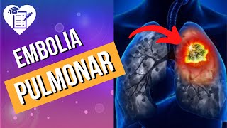 EMBOLIA PULMONAR – Causas Sintomas e Tratamento [upl. by Ettena]