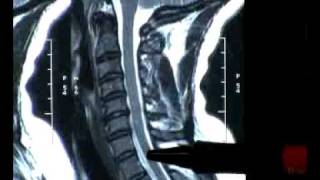 Atlanta Physical Therapy  Neck Pain MRI  Spinal Decompression [upl. by Pry923]