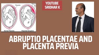 Abruptio placentae and placenta previawhat are these conditions APH bleeding abruption previa [upl. by Aivekal]