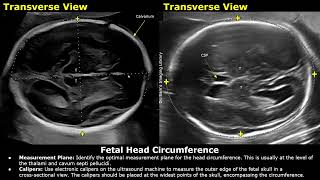 How To Measure Fetal Head Circumference HC On Ultrasound  Biometric Parameters  Obstetric USG [upl. by Sissel]