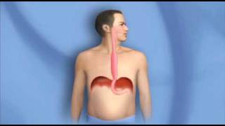 Surgery for Esophagus Cancer Esophagectomy  Mayo Clinic [upl. by Lodge]