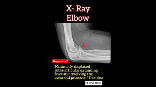 Coronoid process of the ulna fracture   Diagnosis  Radiology [upl. by Buschi]