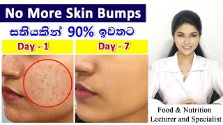 Best Treatment for Oily Skin Bumps with Scientific Explanation  Magical ResultsJust one ingredient [upl. by Innes]