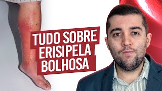 Atualização sobre a erisipela bolhosa e má circulação prevenção tratamento exames e quais riscos [upl. by Angel]