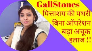 Gallstones symptoms amp homeopathic treatment  gallbladder stones symptoms amp homeopathic medicine [upl. by Jenelle]