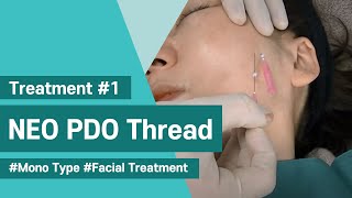 NeoGenesis Thread Series PDO Mono Type Facial Treatment [upl. by Primo375]