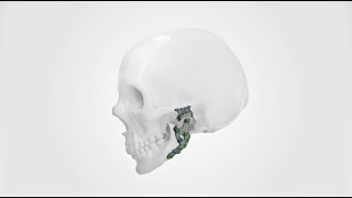 IPS Implants® TMJ Prosthesis [upl. by Molahs]