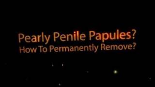 How To Permanently Remove Pearly Penile Papules From Home [upl. by Padgett]