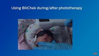 Using Philips BiliChek DuringAfter Phototherapy [upl. by Bocaj383]