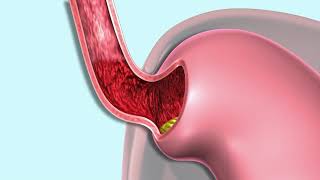 Gastroesophageal Reflux GERD [upl. by Block]