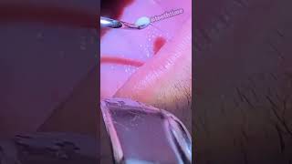 Deep Tonsil Stone Removal  Tonsil Stones  Tooth Time Family Dentistry New Braunfels Texas [upl. by Siraved]