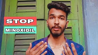 6 months minoxidil beard growth journey results review how to grow beard 🪴 minoxidil beard [upl. by Hurless364]