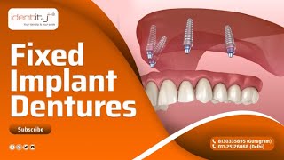 Fixed Implant Denture  Dr Sharad Gupta [upl. by Daniels]