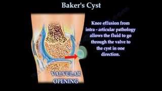 Bakers Cyst  Everything You Need To Know  Dr Nabil Ebraheim [upl. by Sherrod]