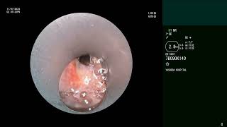 Endobronchial Nocardiosis  Bronchoscopy [upl. by Sivrep]