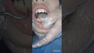 تنظيف جير الاسنان  الطريقة اليدوية dentist اسنان العنايه stitch اكسبلور تسوسالاسنان [upl. by Lrac650]