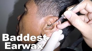 Removing Mans Baddest Earwax  Watch How Its Done [upl. by Butterworth392]