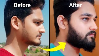 Minoxidil Beard Growth  6 Month Transformation  Before and After All Picture [upl. by Kryska790]