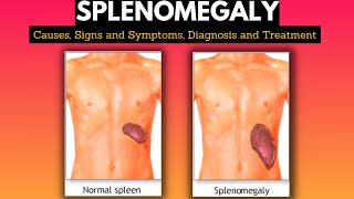 Splenomegaly Causes Signs and Symptoms Diagnosis and Treatment [upl. by Aizatsana]