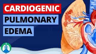 Cardiogenic Pulmonary Edema Medical Definition  Quick Explainer Video [upl. by Trow93]