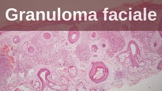 Granuloma Faciale  Pathology mini tutorial [upl. by Laamaj37]