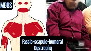 Fascioscapulohumeral Dystrophy A rare Degeneration of Muscles mbbs neetpg [upl. by Henden]