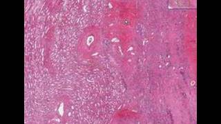 Histopathology KidneyWilms tumor [upl. by Enoved639]