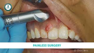 Painless Laser Surgery of Oral Epulis [upl. by Ecirp]