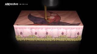 Tattoo Removal  Picoway Resolve Teaser 3D Medical Device Animation [upl. by Roehm]