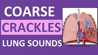 Crackles Coarse Lung Sounds  Crackles and Rales Breath Sounds Abnormal [upl. by Haelak916]