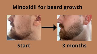 My results from using minoxidil for beard growth [upl. by Assital]