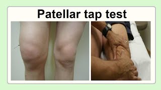 patellar tap test [upl. by Schargel247]