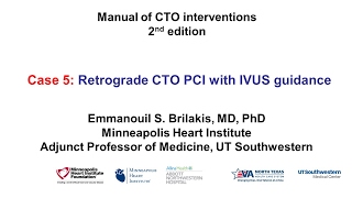 Case 5 Manual of CTO Interventions  IVUS guidance for retrograde CTO PCI [upl. by Yesrej]