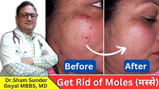 Mole मस्से Removal Procedure  Get Rid of Moles [upl. by Valerio132]