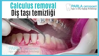 Calculus removal  Diş taşı temizliği [upl. by Grannia272]