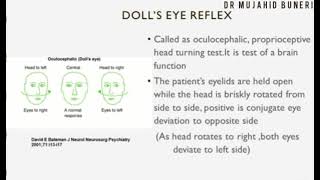 Dolls Eye Reflex  Oculocephalic Reflex  Brain death  Dr M B [upl. by Groos]