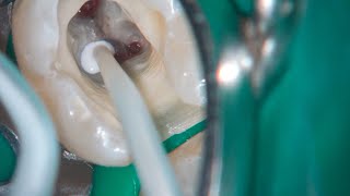 DRendo  Full pulp chamber pulpotomy in a mandibular second molar [upl. by Alyos489]