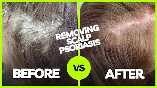 Removing Plaque Scalp Psoriasis  Using The AntiFungal Bundle myhappyscalpcom [upl. by Coletta]