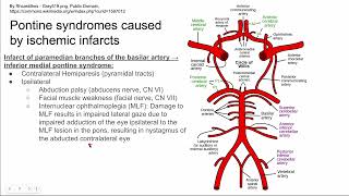 Pontine syndromes caused by ischemic infarcts [upl. by Ayahs]