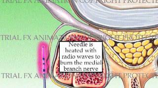 Radiofrequency Rhizotomy [upl. by Sherrer]