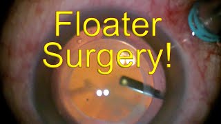 Surgery for EYE FLOATERS MASSIVE  Vitrectomy for eye floaters  Dr Simon Chen [upl. by Clarisa998]