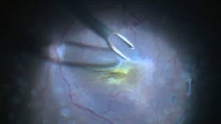 Epi Retinal gliosis Removal [upl. by Juna]