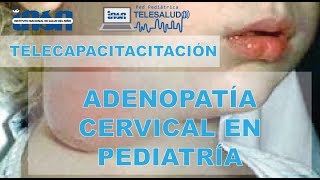 Adenopatía Cervical en Pediatría  Telecapacitación INSN [upl. by Selle90]