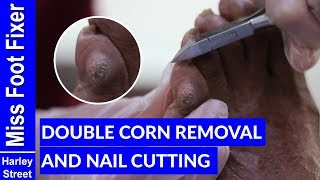 SATISFYING DEEP CORN EXTRACTION REMOVAL AND NAIL CUTTING BY MISS FOOT FIXER [upl. by Marcoux]