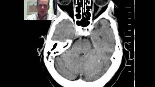 DISCUSSION of CT Head in 76yo patient with an acute MCA stroke [upl. by Ecnaralc]