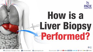 Liver Biopsy  Vim Silverman Liver Biopsy needle  Made Easy  Doodle Animation [upl. by Brennan]