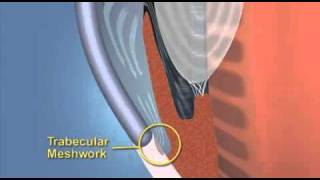 Primary Angle Closure Glaucoma Explained With Animation [upl. by Marisa]