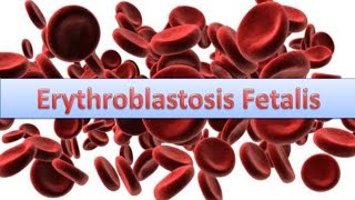 Erythroblastosis fetalisHaemolytic disease of New bornHDN [upl. by Talie]