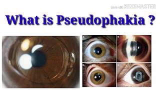 What is pseudophakia  sign  Intraocular lens  sharp vision [upl. by Alahsal]